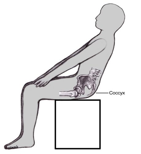 Coccydynia