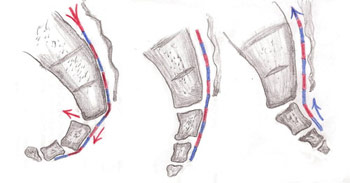 Sakit tulang ekor_Coccydynia
