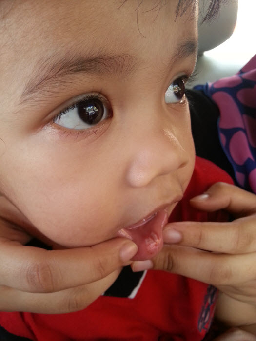 Khair injured - Ulcer besar
